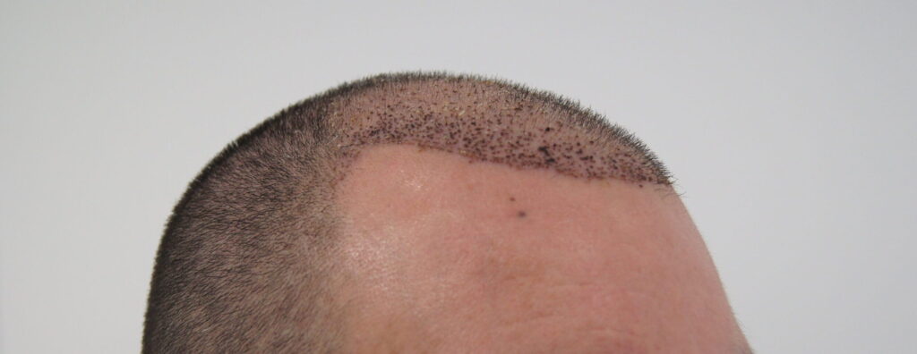 Tratamiento de alopecia en Bogotá Colombia