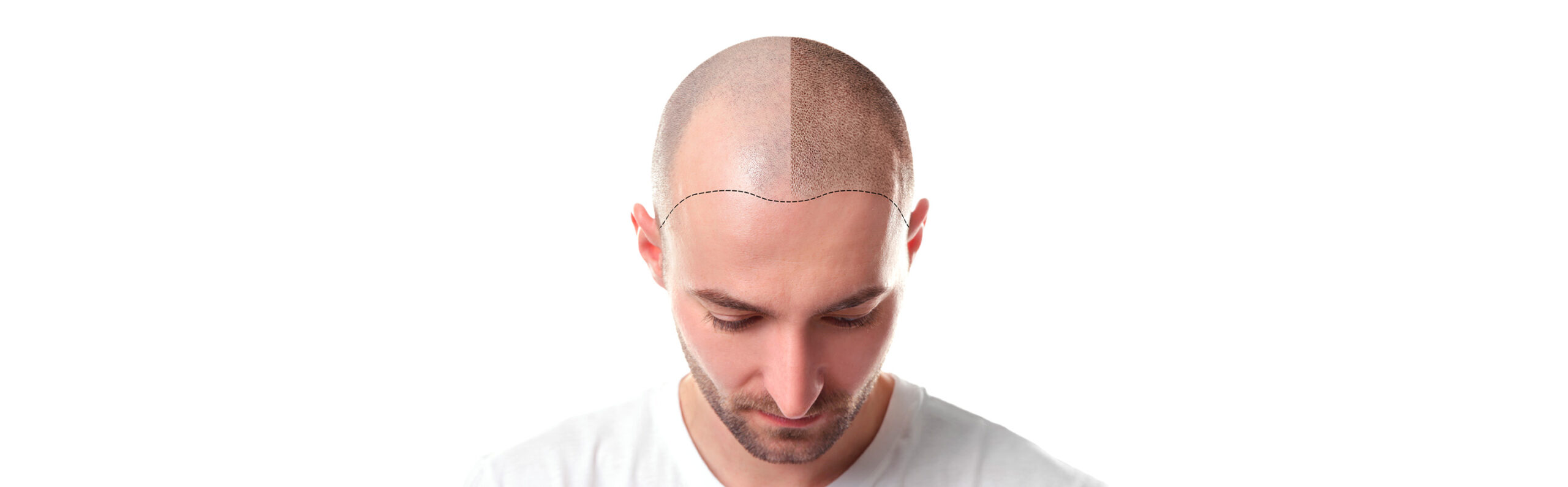 Alopecia o caída del cabello