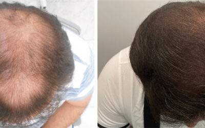 Implante Capilar: Casos de éxito en Bojanini Hair & Skin Experts