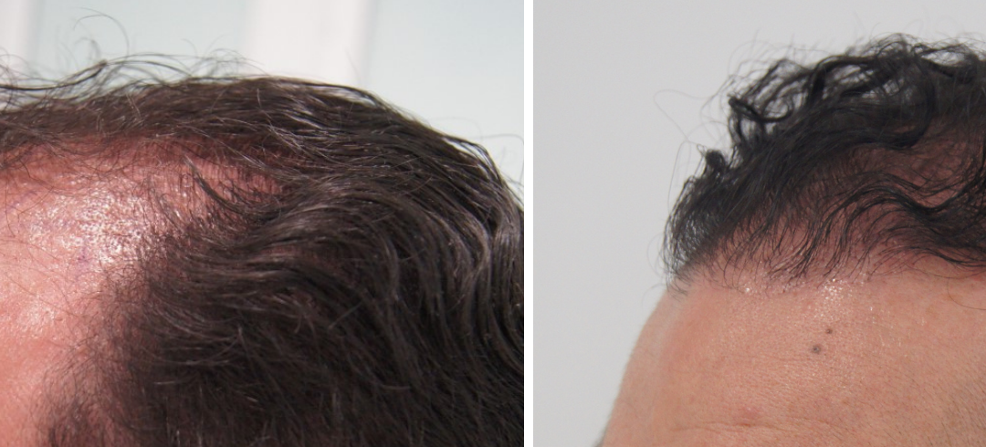 Implante Capilar: Casos de éxito en Bojanini Hair & Skin Experts
