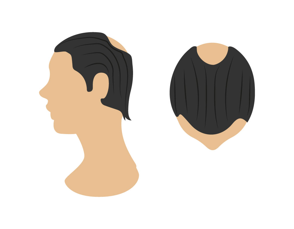 alopecias 01 Bojanini Colombia