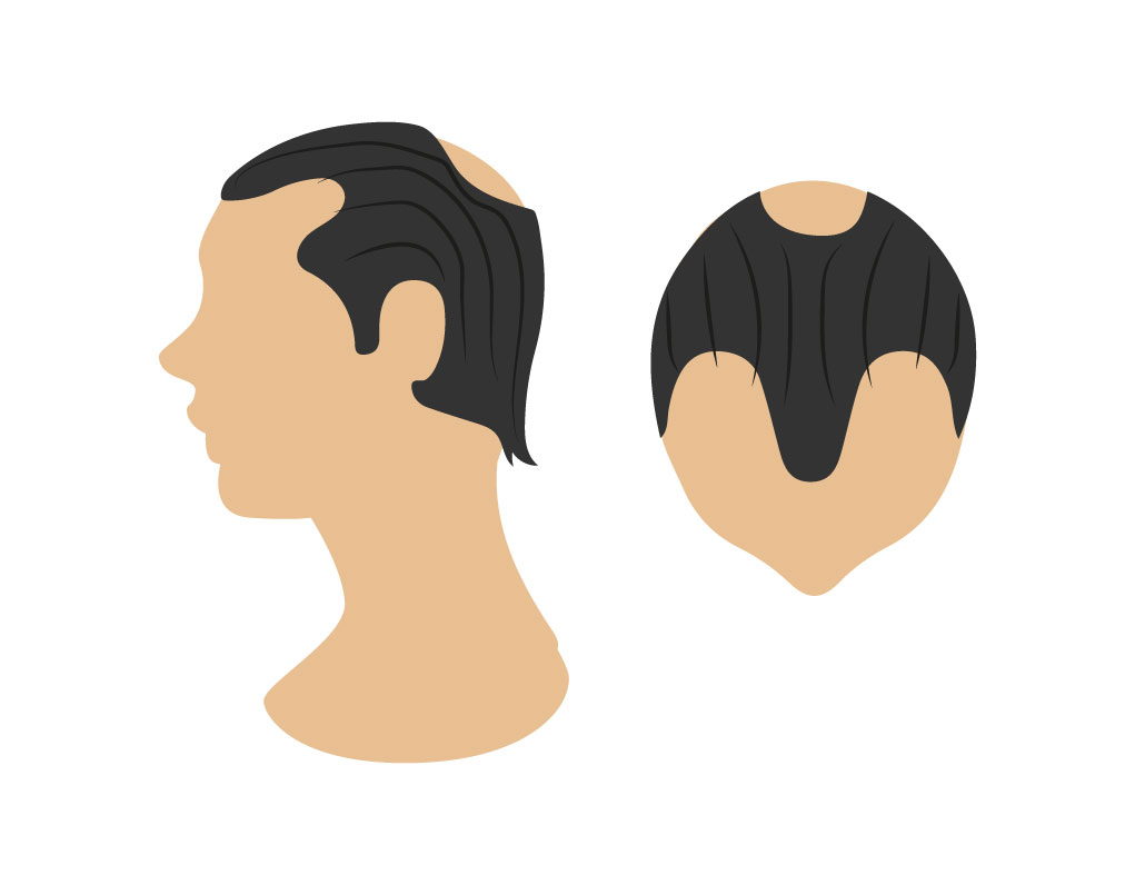 alopecias 03 Bojanini Colombia