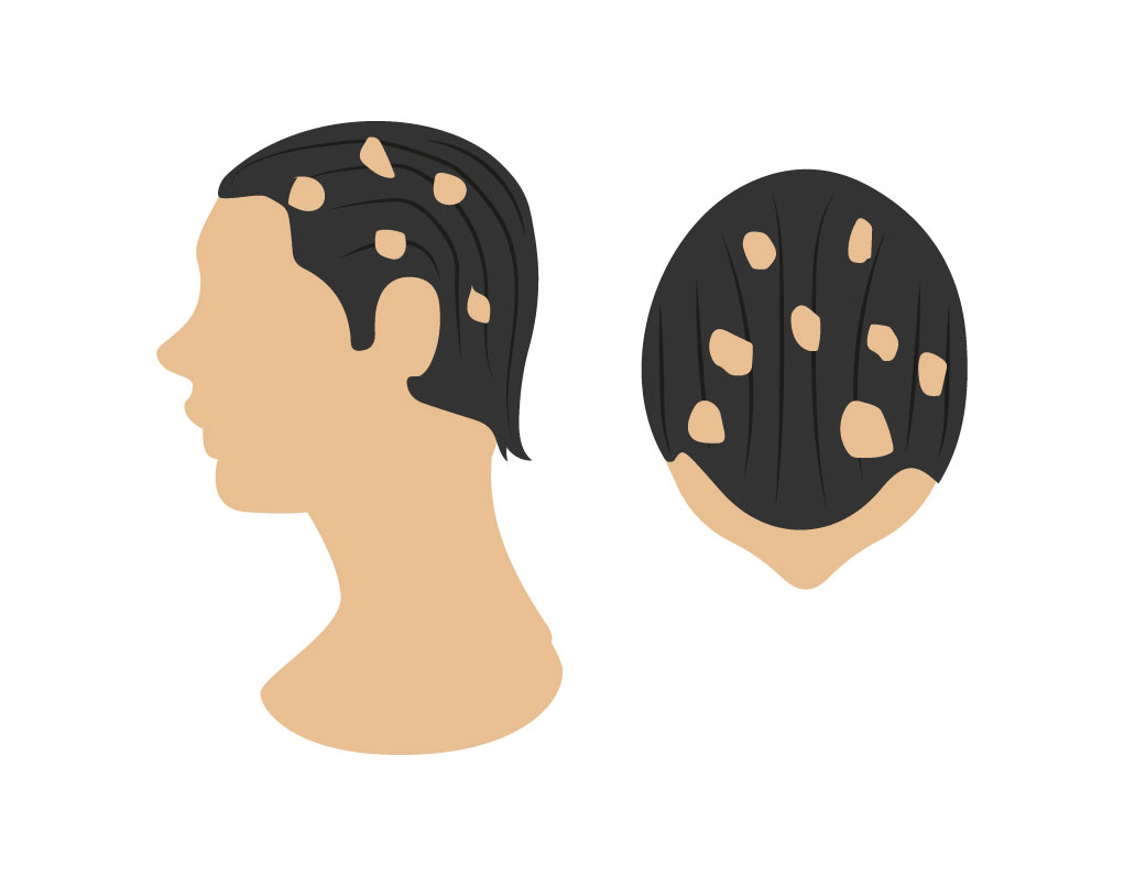 alopecias 04 Bojanini Colombia