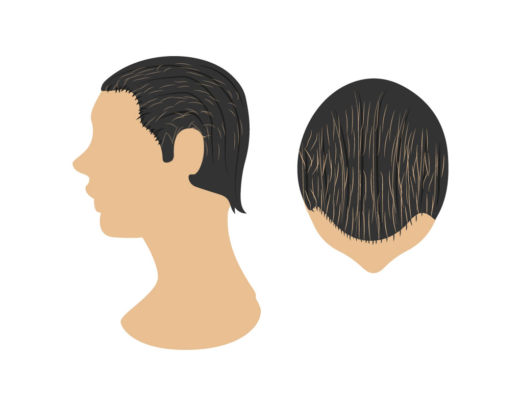 alopecias 05 Bojanini Colombia