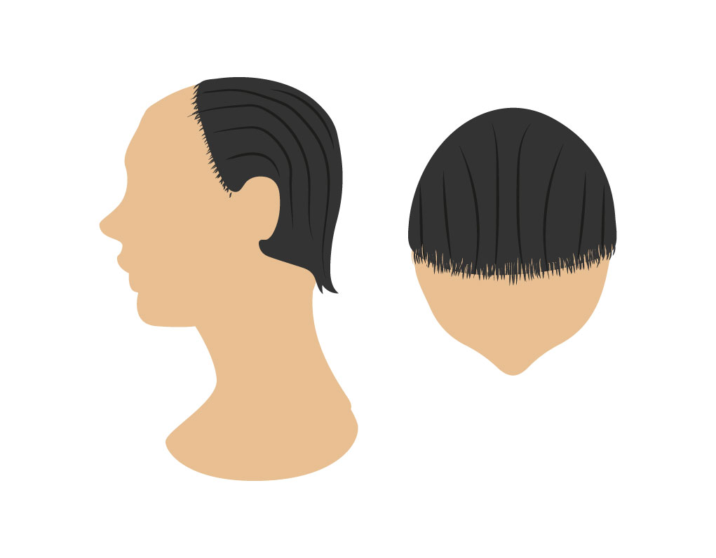 alopecias 06 Bojanini Colombia