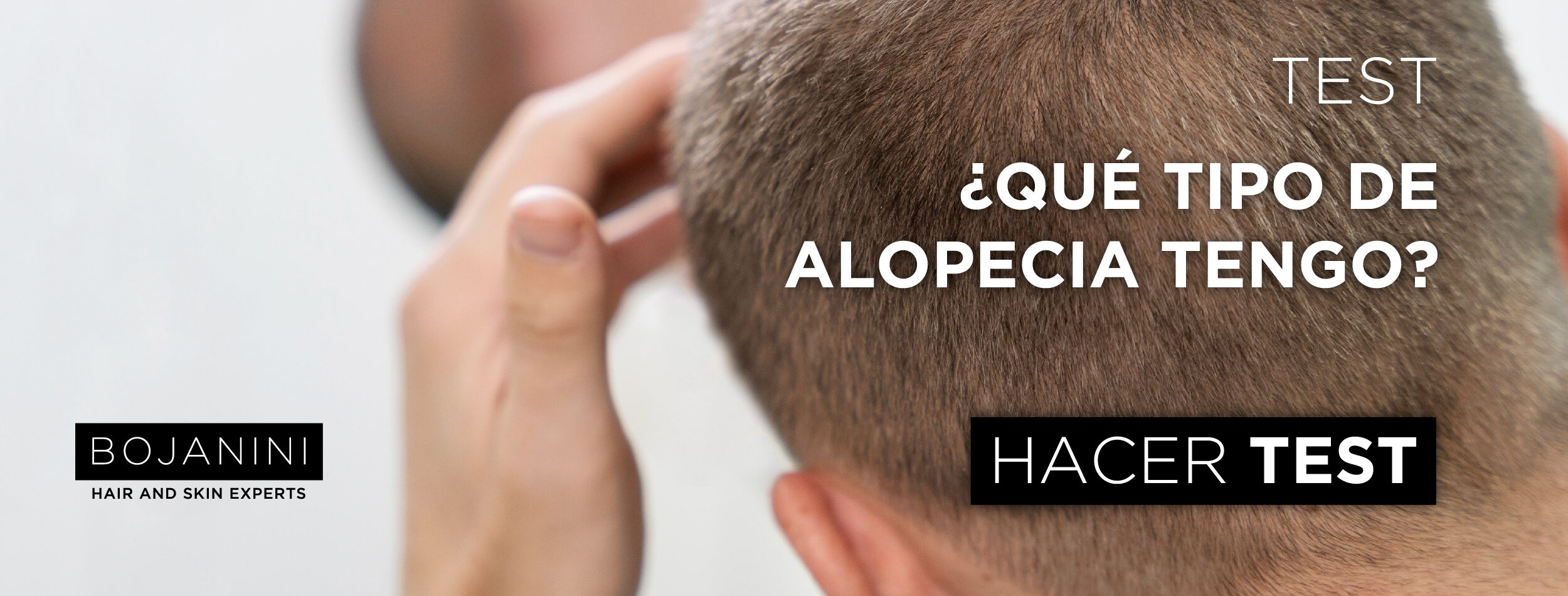 tipos de alopecia