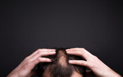Tipos de Alopecia y Cómo Tratarlos en Bojanini Experts 